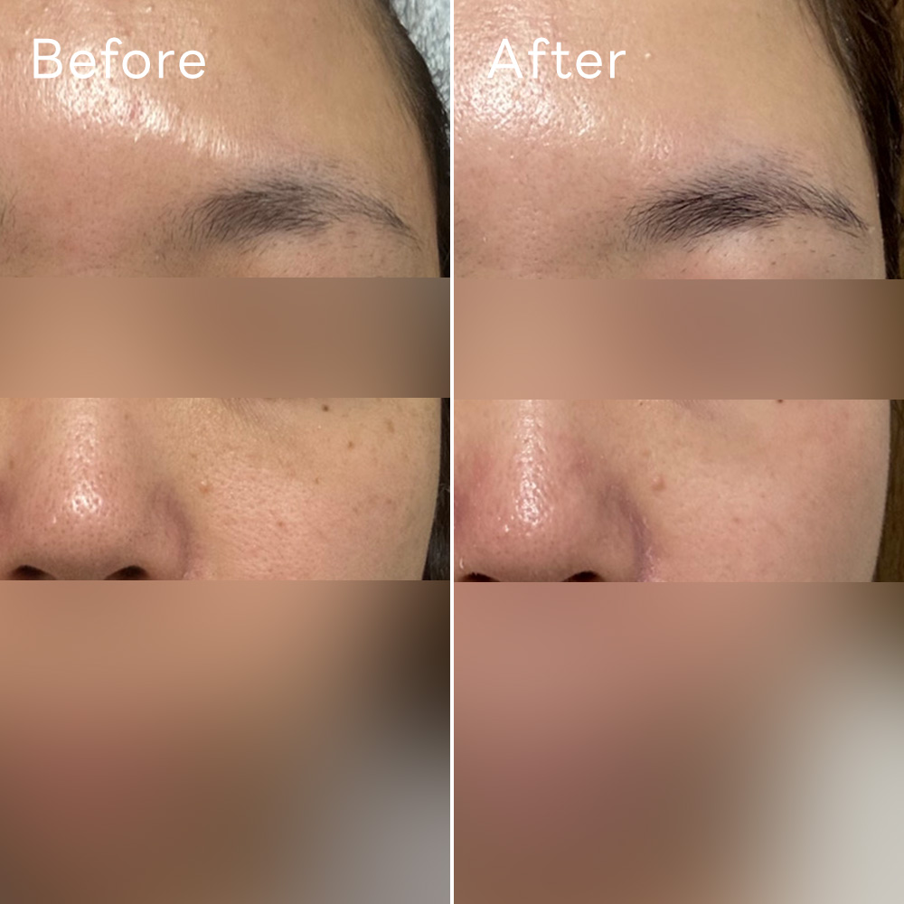 ゼオスキンヘルス（ZO SKIN HEALTH） セラピューティックプログラム症例