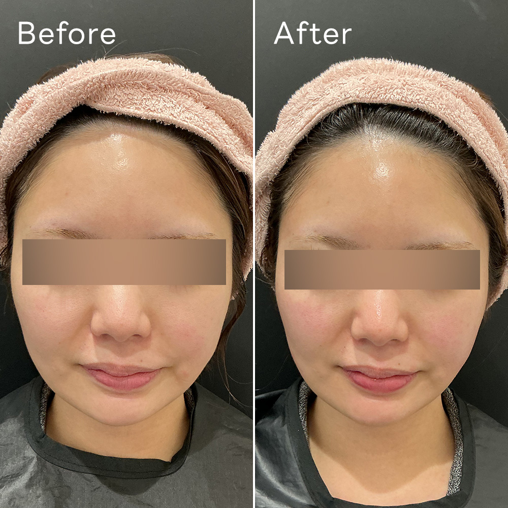 ジャルプロ グロウピール症例