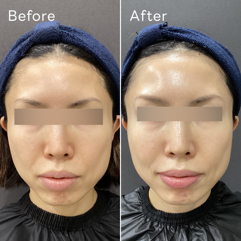 ジャルプロスーパーハイドロ(肌育注射)症例