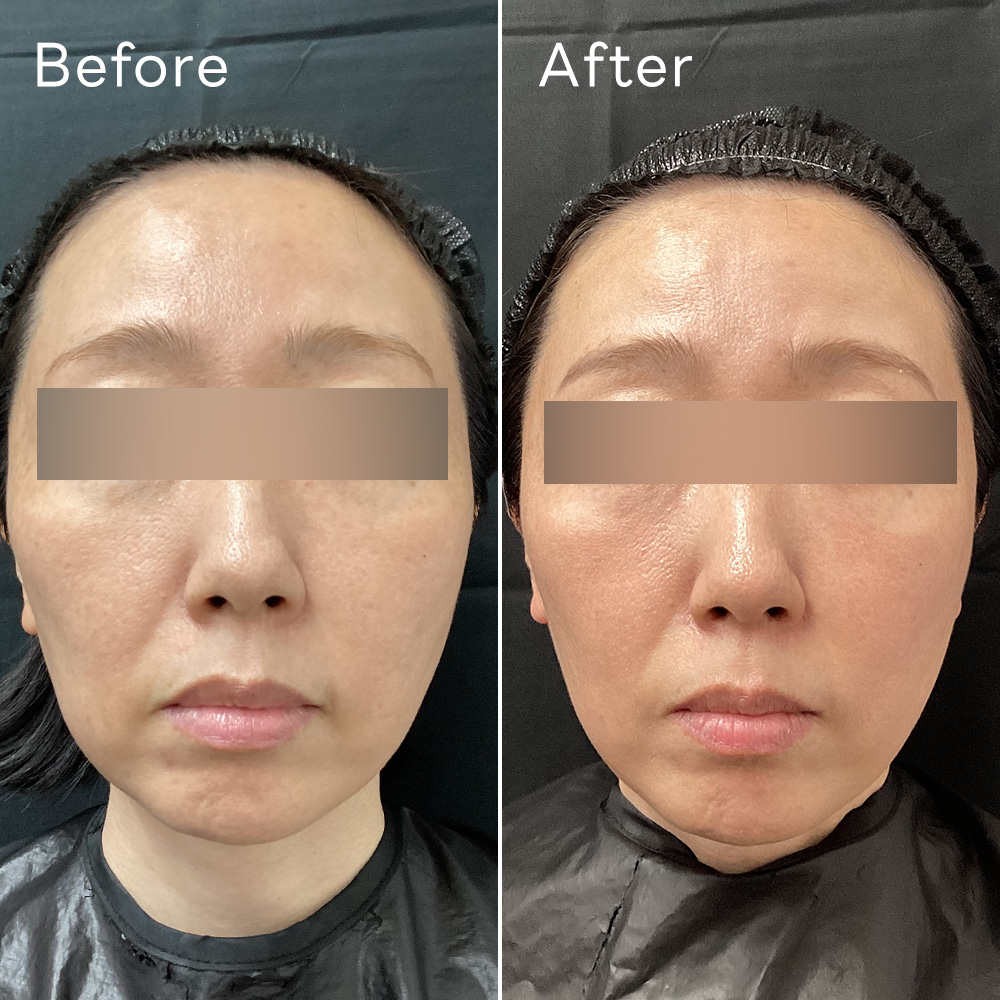 ジャルプロスーパーハイドロ(肌育注射)症例